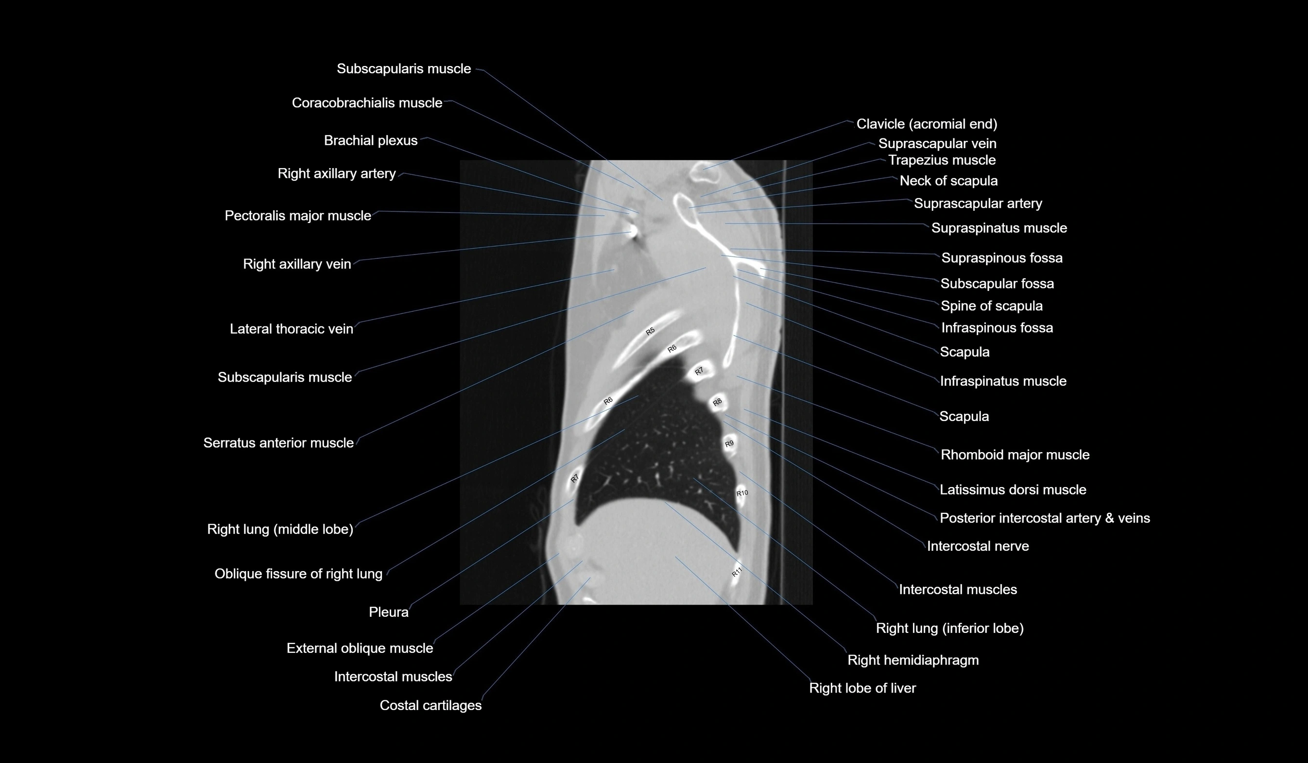CT chest (thorax) lung window labelled sagittal cross sectional anatomy radiology image-00022.webp